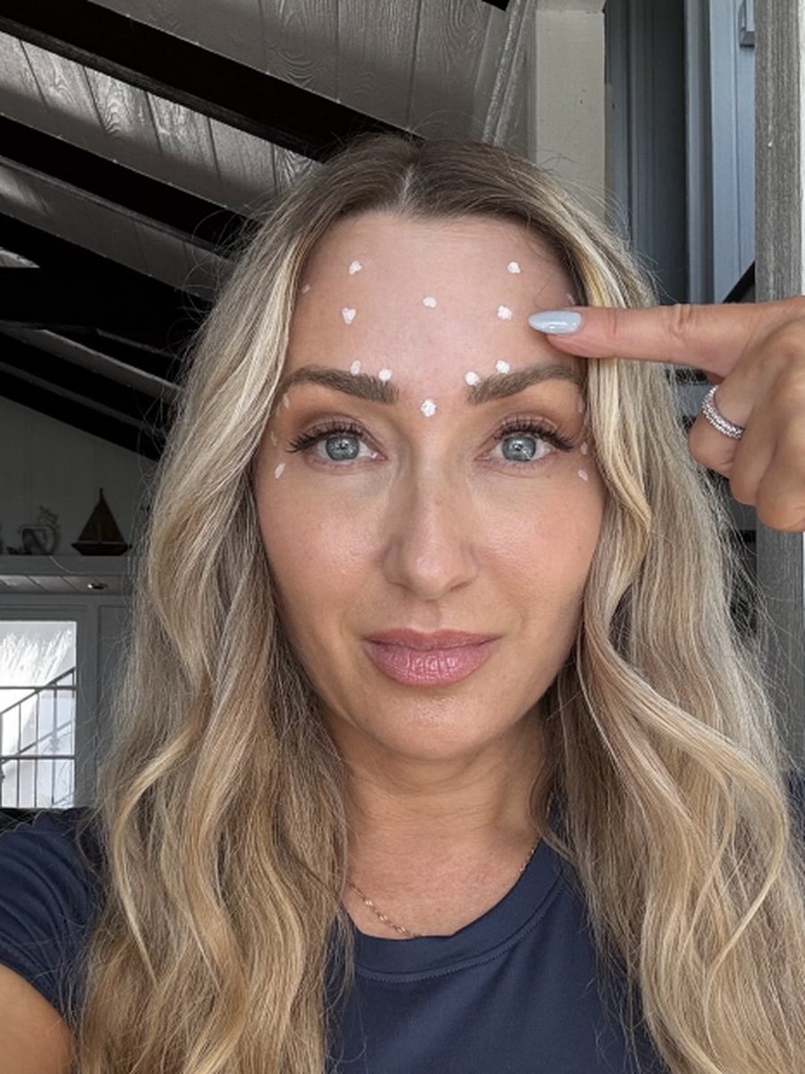 Nicole mapping Botox points